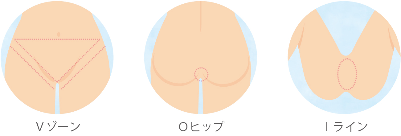 宮城県仙台市・南仙台・名取市でVIO医療脱毛を提供しているおくぐち皮ふ科クリニックのVIO脱毛の照射範囲の画像