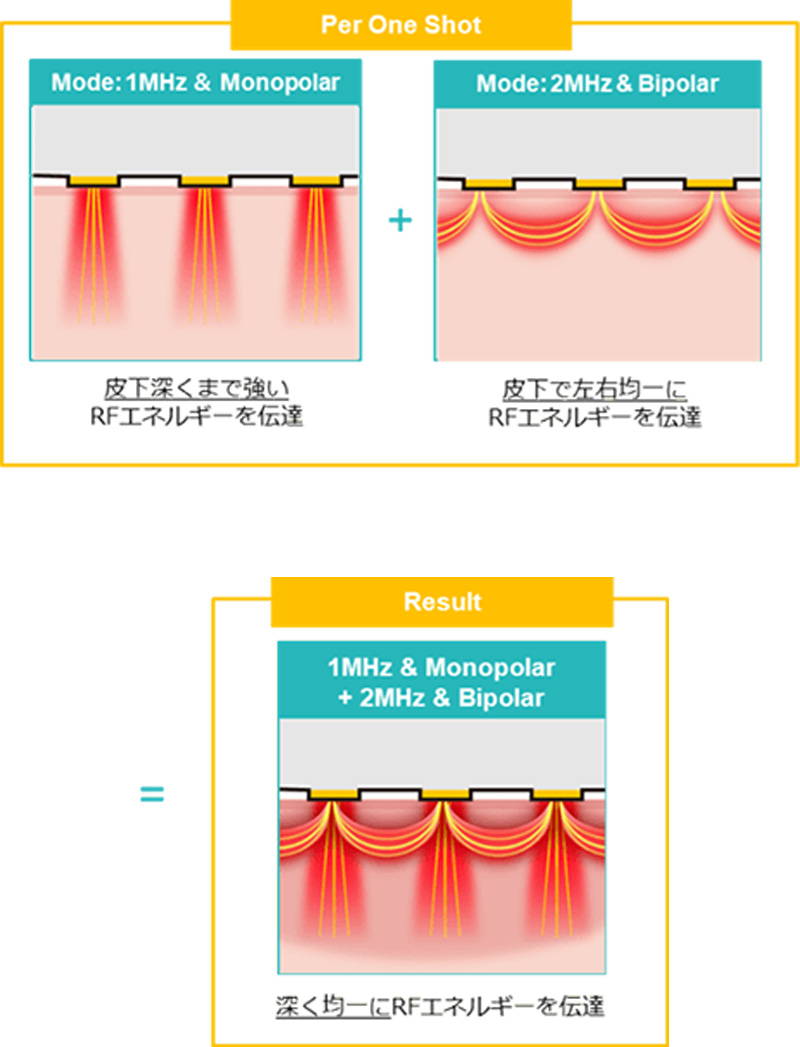 皮下深くまで強いRFエネルギーを伝達＋皮下で左右にRFエネルギーを伝達＝深く均一にRFエネルギーを伝達
