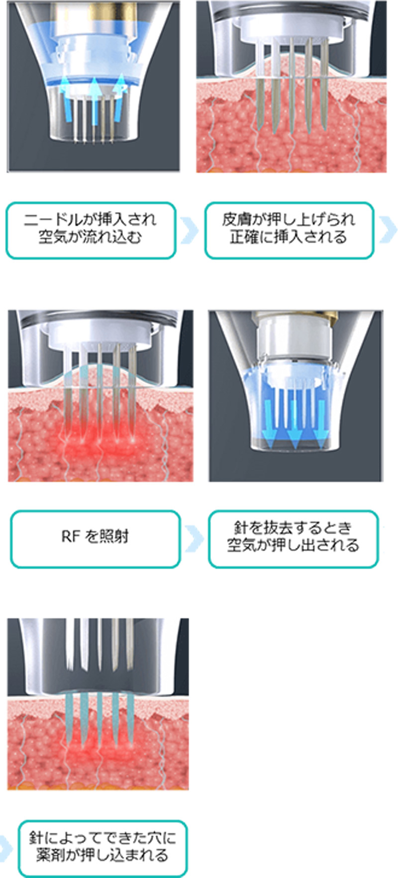 ニードルが挿入され、空気が流れ込む⇒皮膚が押し上げられ正確に挿入される⇒RFを照射⇒針を除去するとき空気が押し出される⇒鍼によってできた穴に薬剤が流し込まれる