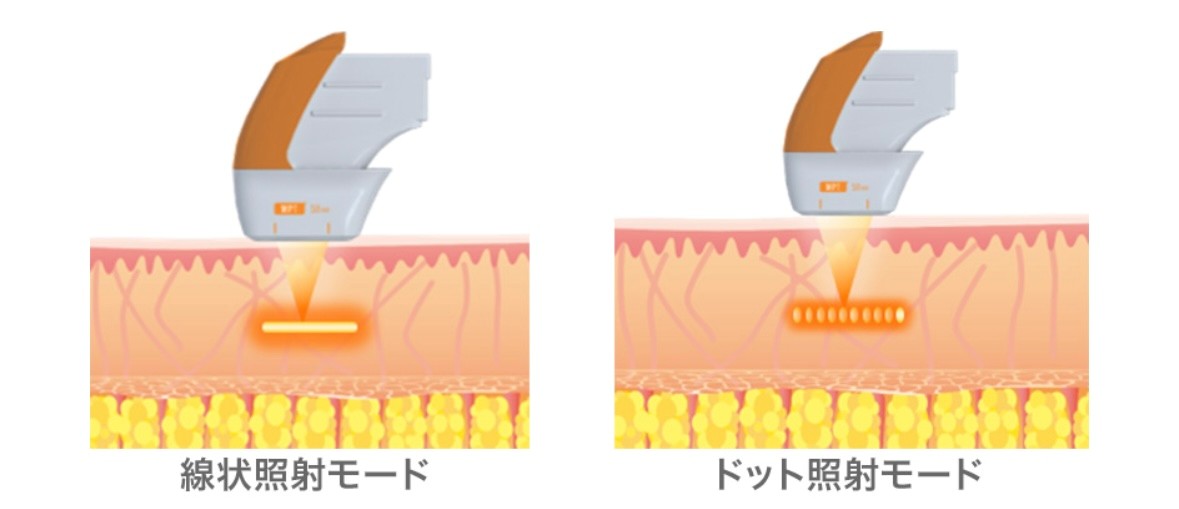 HIFU(高密度焦点式超音波)のイメージ画像